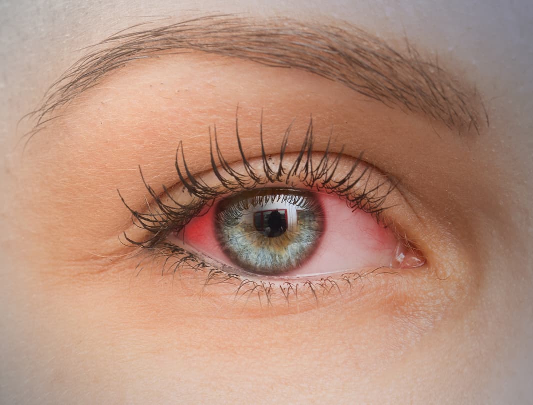 Pink Eye Hero